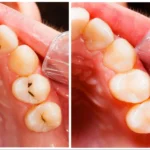 The Hidden Signs: what does a cavity look like​ and How to Spot It Early