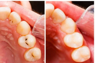 The Hidden Signs: what does a cavity look like​ and How to Spot It Early